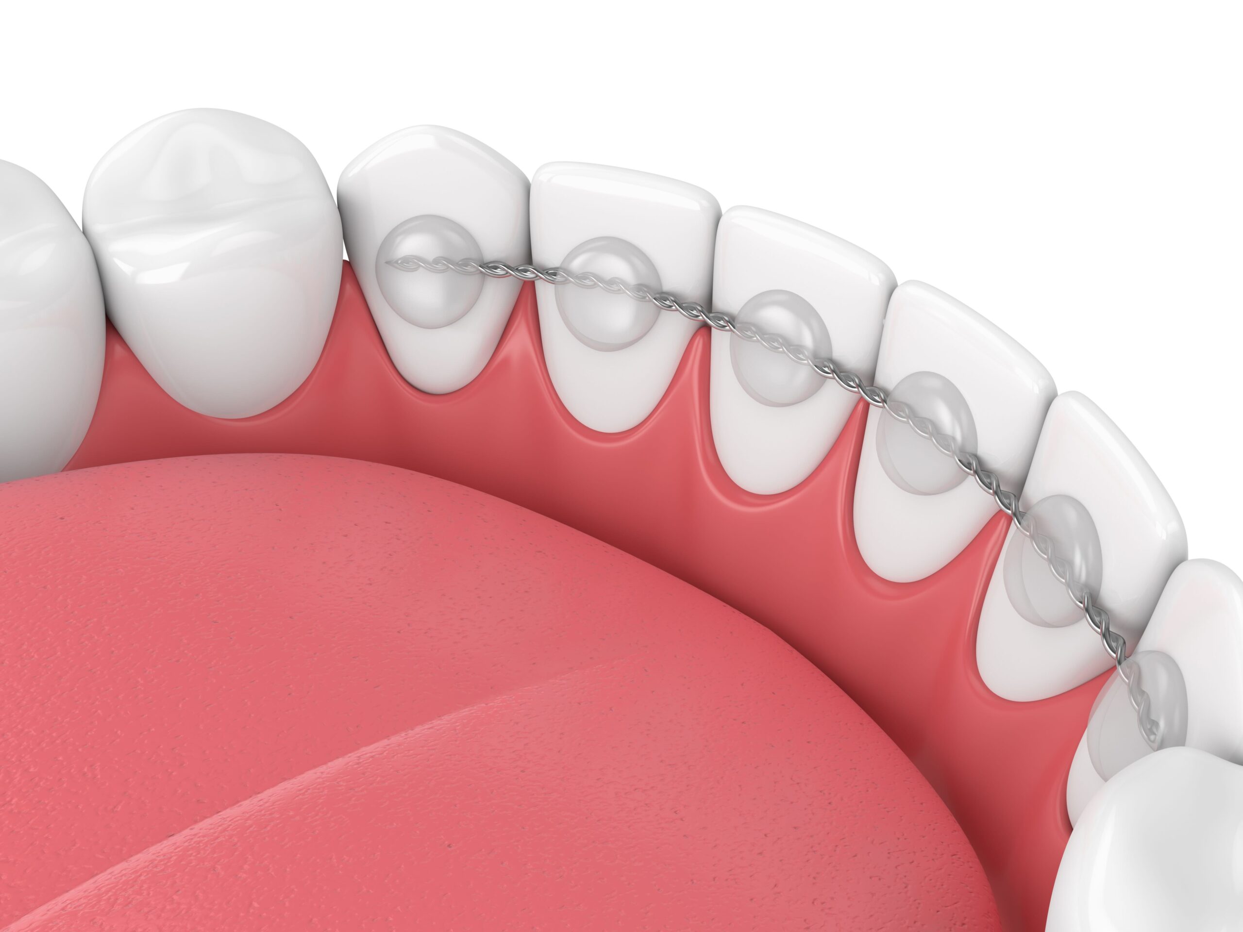 Close-up illustration of teeth with a lingual retainer attached. Pink tongue and gums visible. No landmarks or historical buildings depicted.