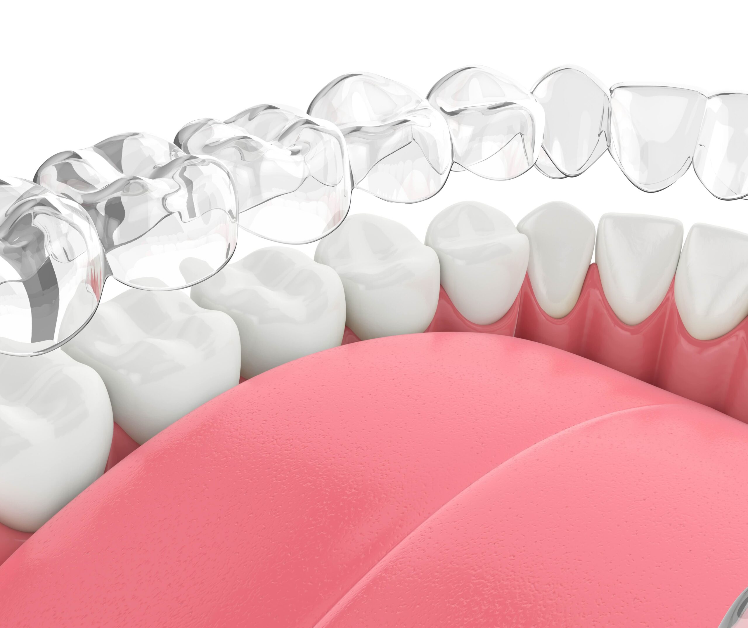 Close-up illustration of clear aligners above a row of white teeth and a pink tongue. Suitable for dental health or orthodontic themes.